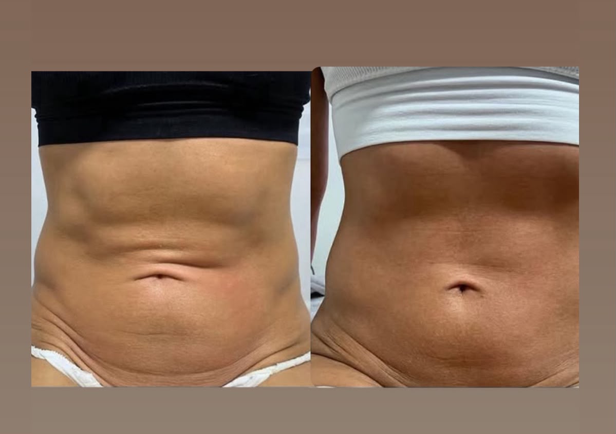Flacidez Abdominal - Firmeza e Definição